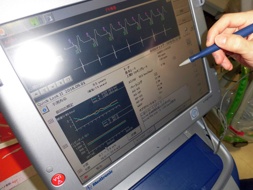 ペースメーカーのデータ