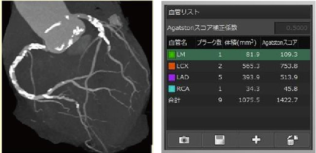 CT石灰化スコアリング
