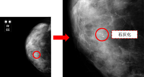 マンモグラフィー画像