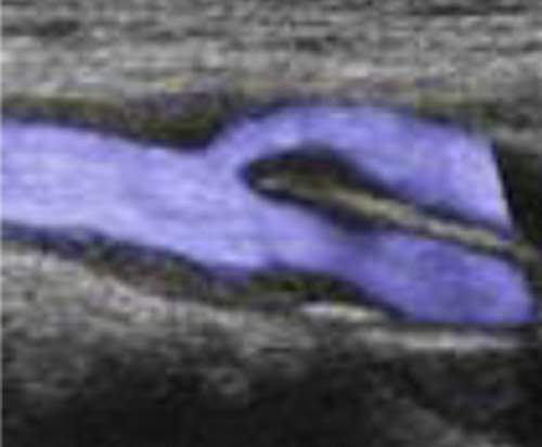 頸部超音波検査